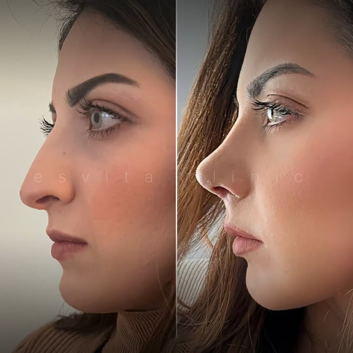 نتائج قبل وبعد عملية تجميل الأنف المفتوحة في عيادة Esvita، إعادة تشكيل الأنف بشكل طبيعي