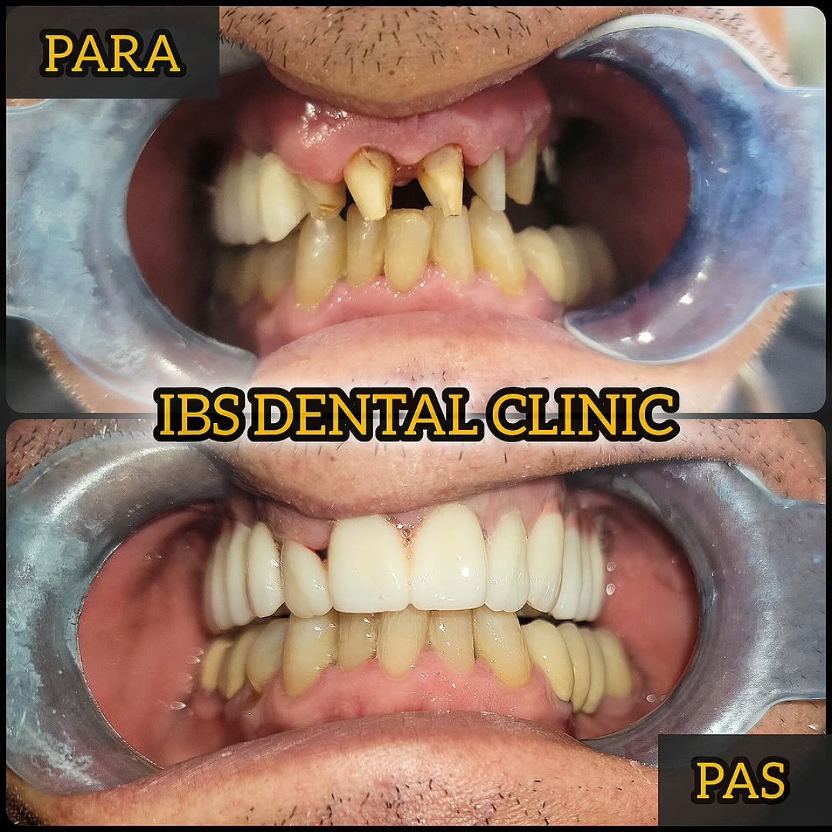 До та після встановлення коронок в IBS | Dental Clinic, відновлена посмішка і результат