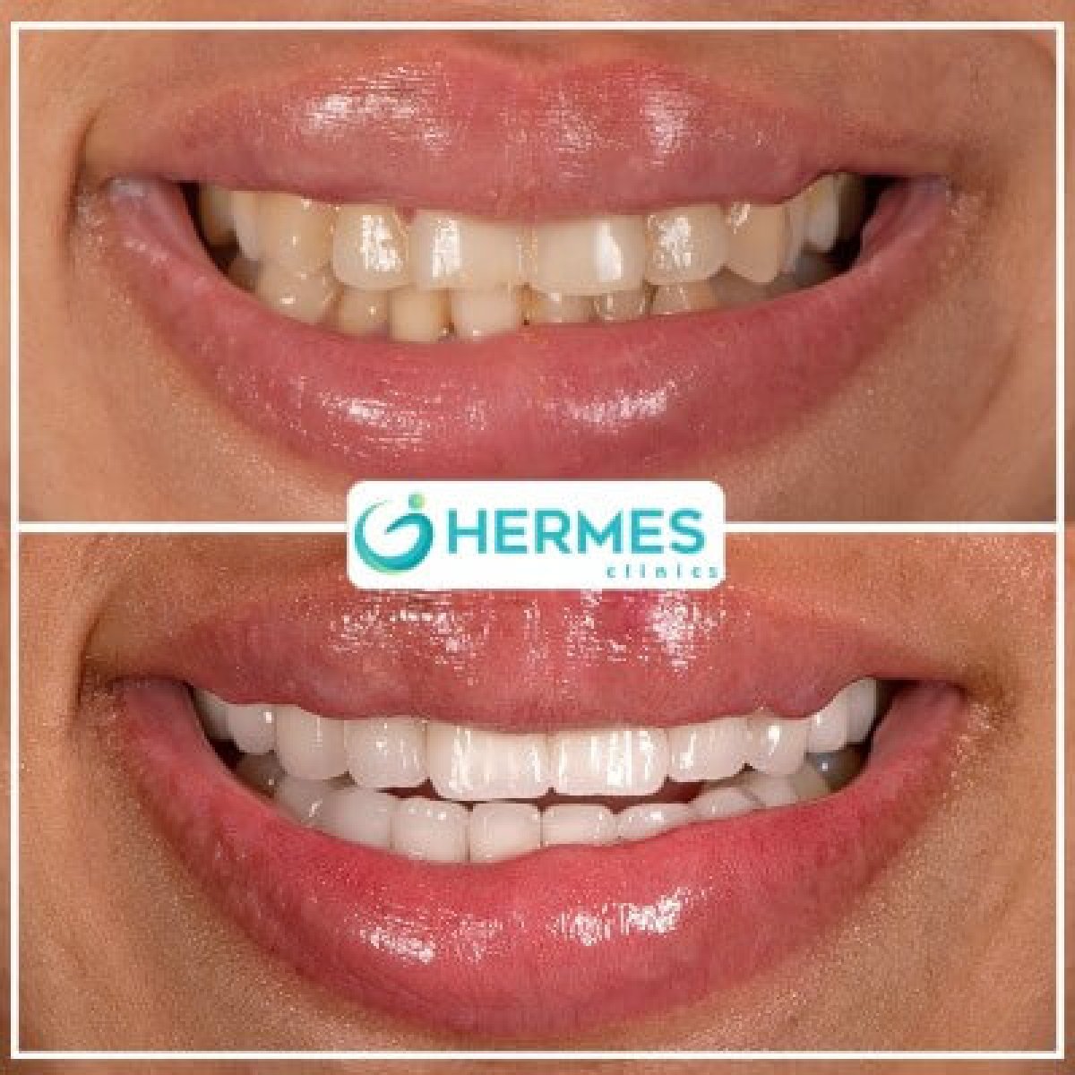 Before and after veneers at Hermes Clinics – smile makeover with whiter, even teeth result