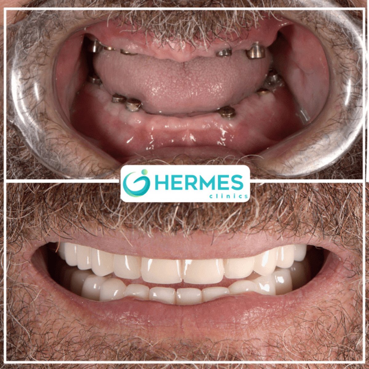 Efekty przed i po implantach Flapless All-on-4 w Hermes Clinics, przywrócony uśmiech