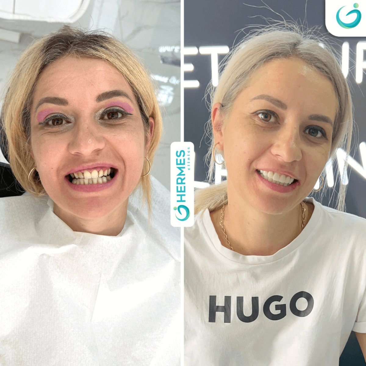 Efekty wybielania zębów przed i po w Hermes Clinics – wyraźnie bielszy uśmiech