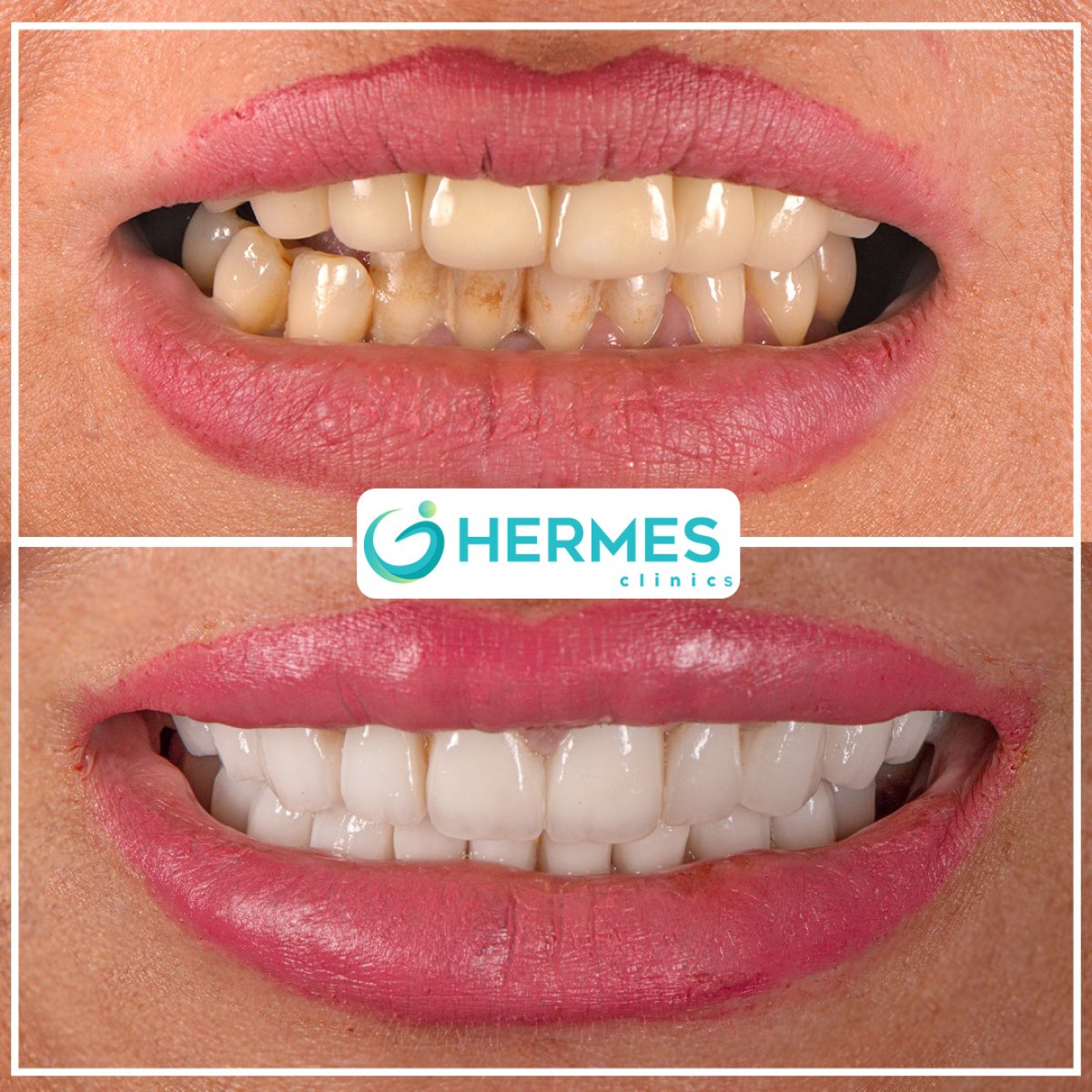 Before and after tooth whitening results at Hermes Clinics – visibly brighter, whiter smile