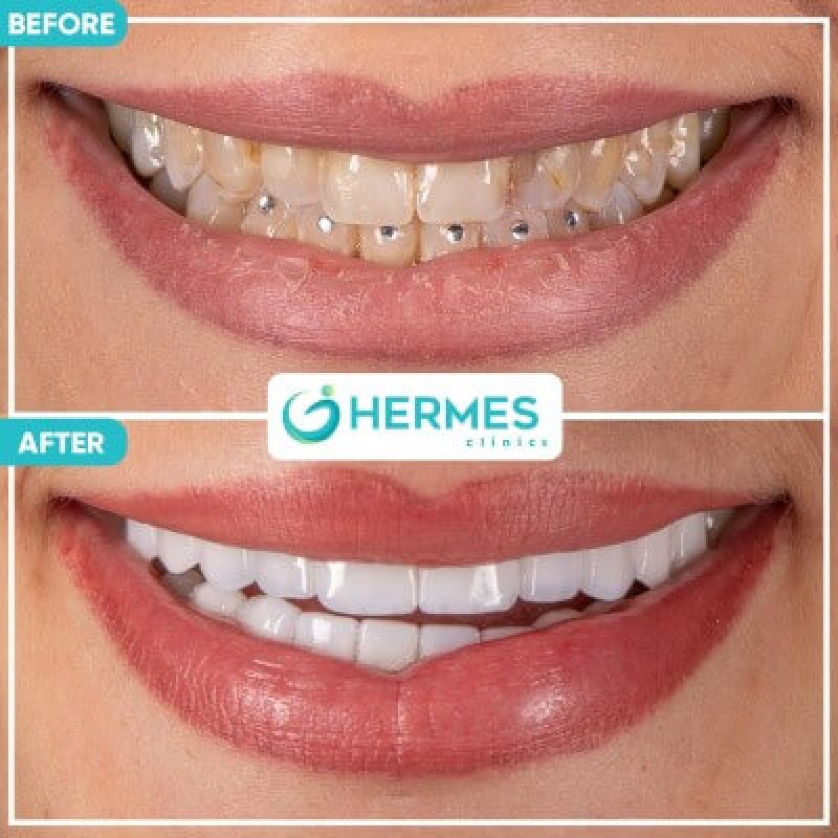 نتائج تبييض الأسنان قبل وبعد في Hermes Clinics – ابتسامة أكثر بياضًا وإشراقًا