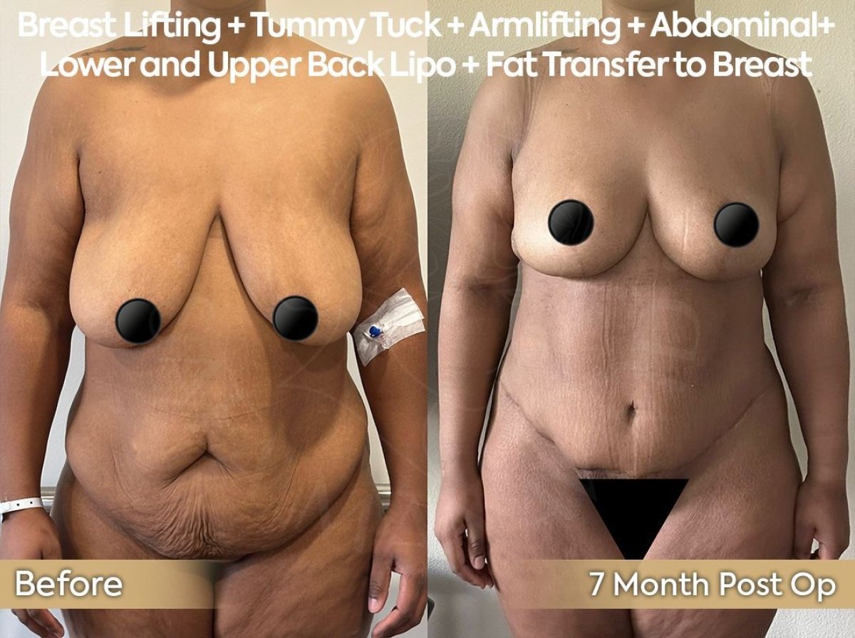 Before and after liposuction and body contouring results at Dr. Safa Manav Clinic, 7 months post-op