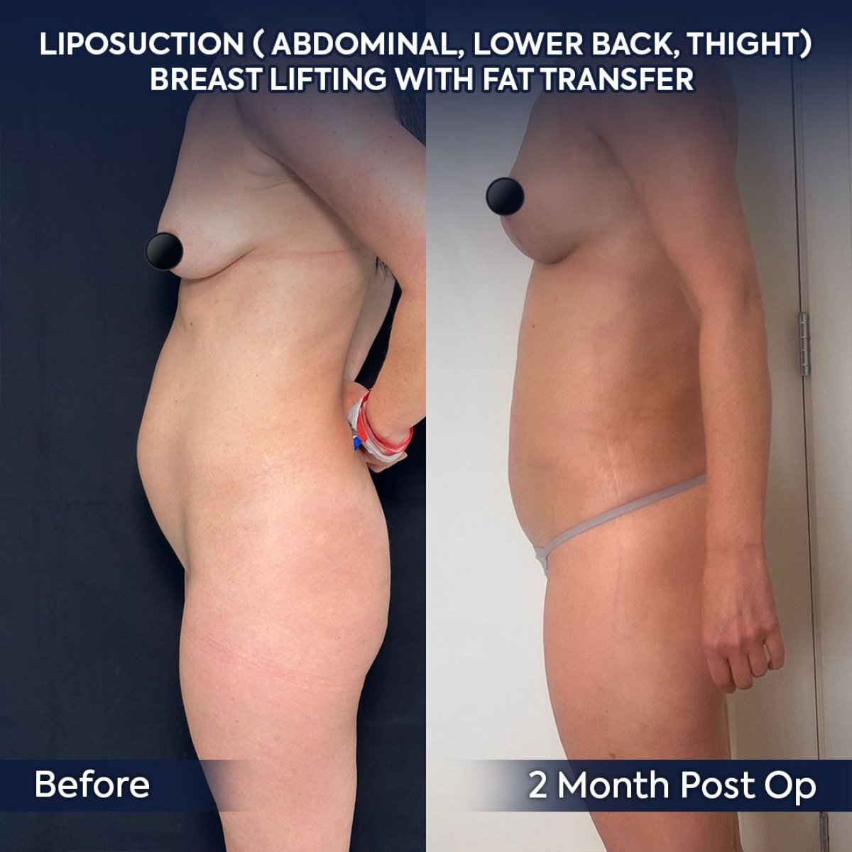 Before and after liposuction and breast lift with fat transfer at Dr. Safa Manav Clinic results
