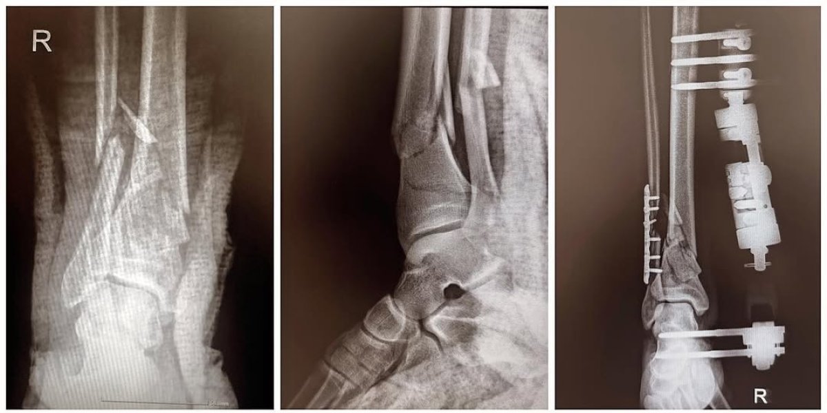 Resultados antes y después del tratamiento de fractura ósea en la clínica Dr Andreas Papadopoulos