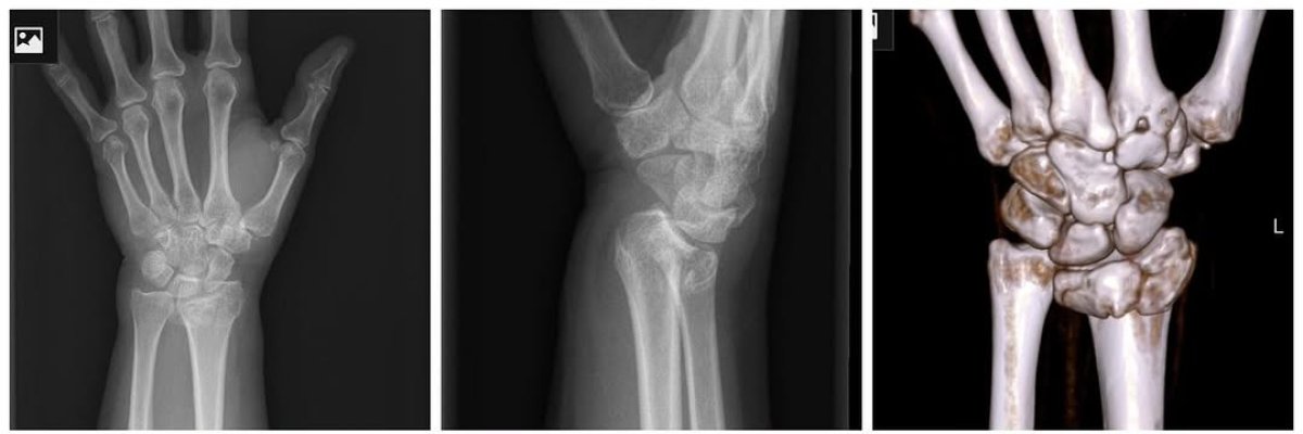 Resultado del tratamiento de fractura ósea en la muñeca en la clínica Dr Andreas Papadopoulos