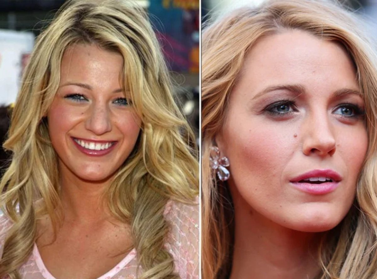 Before and after rhinoplasty results at DR. CINIK HOSPITAL, nose reshaping with natural look