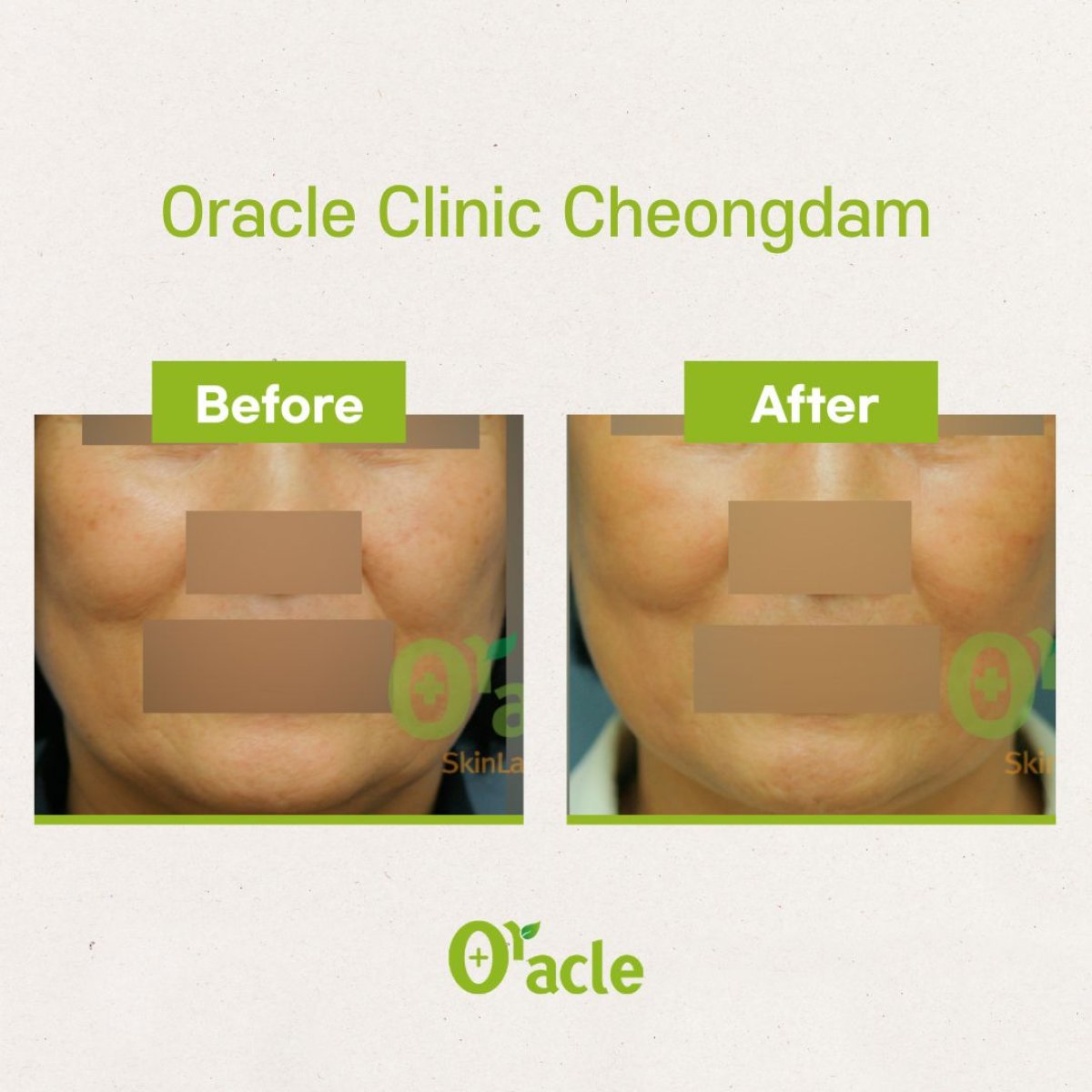 نتائج شد الوجه قبل وبعد في Oracle Clinic Cheongdam، تجديد واضح للبشرة
