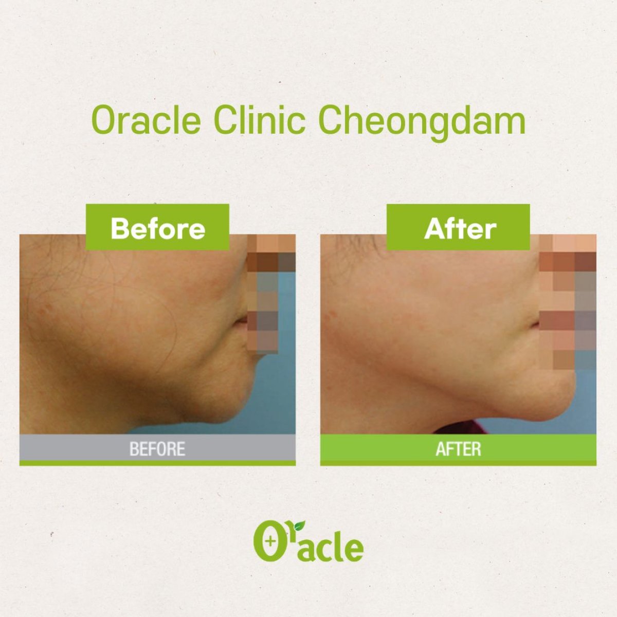 Resultados de lifting facial antes y después en Oracle Clinic Cheongdam, mandíbula más firme