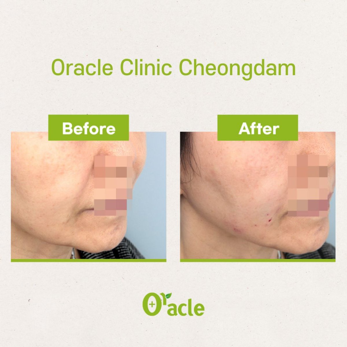 نتائج شد الوجه قبل وبعد في Oracle Clinic Cheongdam، تحسين واضح لتحديد الوجه