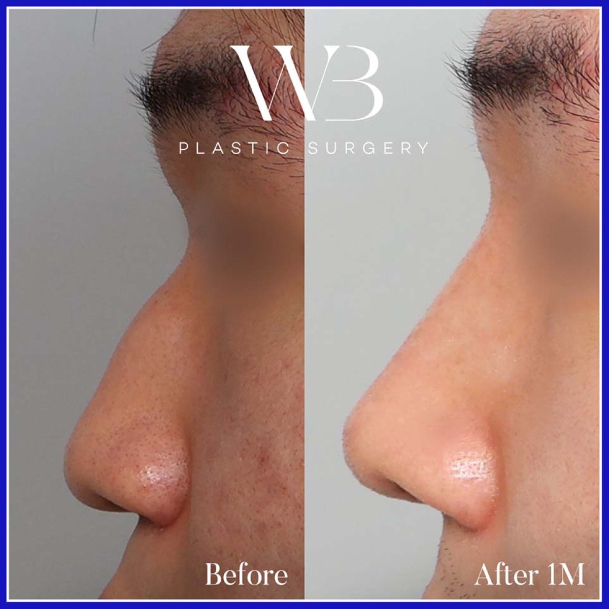 Efekty przed i po rhinoplastyce w WillBe Plastic Surgery Clinic, poprawiony profil nosa