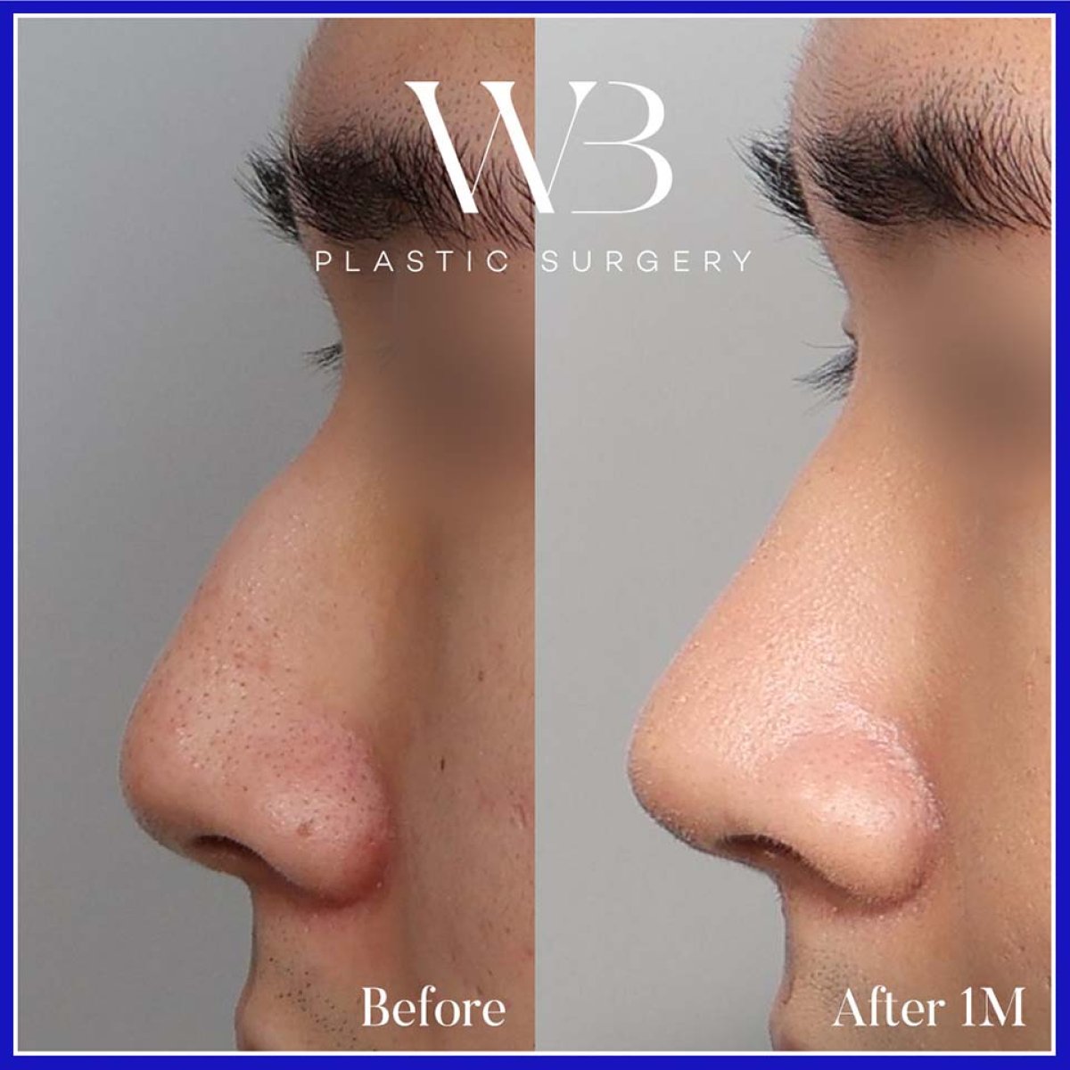 Результати ринопластики до і після у WillBe Plastic Surgery Clinic, покращений профіль носа