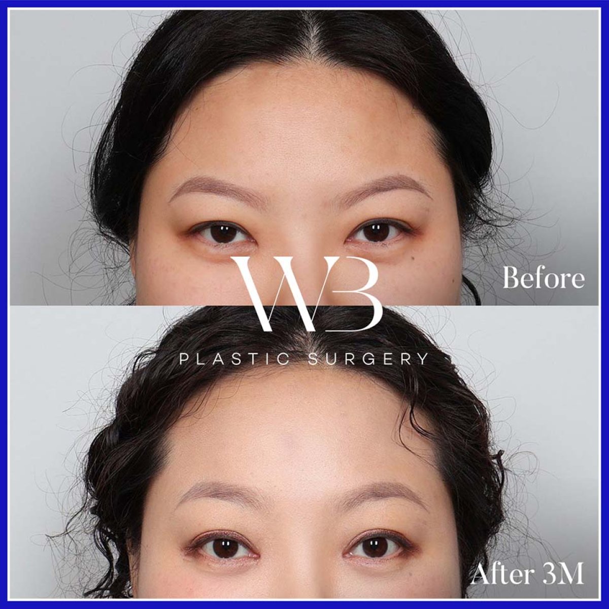 Forehead lift before and after results at WillBe Plastic Surgery Clinic, visible brow elevation