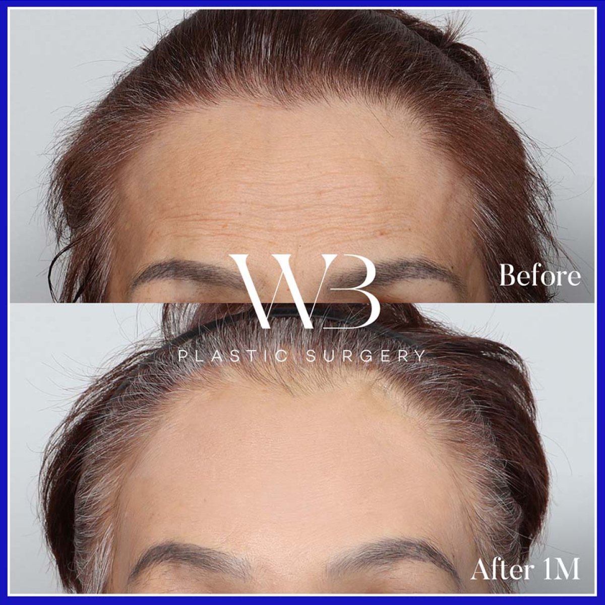 Resultados de lifting de frente antes y después en WillBe Plastic Surgery Clinic, piel más lisa