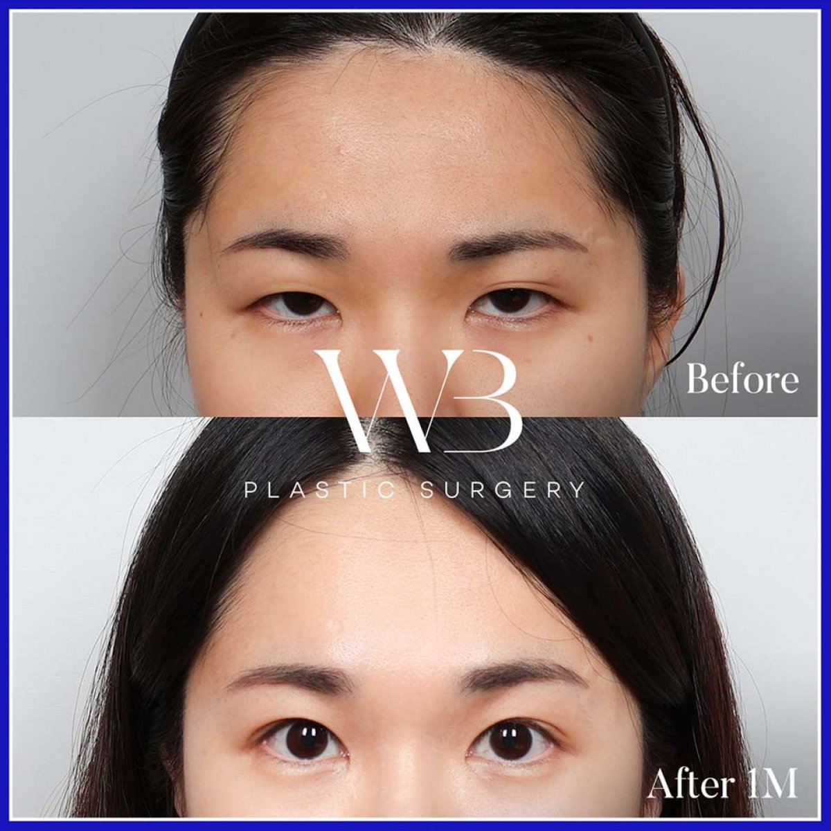 Forehead lift before and after results at WillBe Plastic Surgery Clinic, smoother brow area