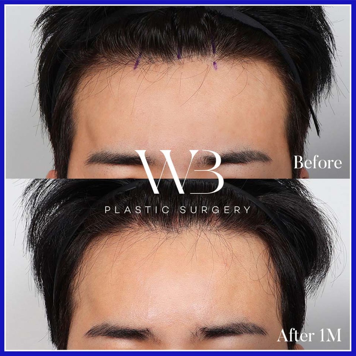 Resultados de lifting de frente antes y después en WillBe Plastic Surgery Clinic, línea capilar mejorada