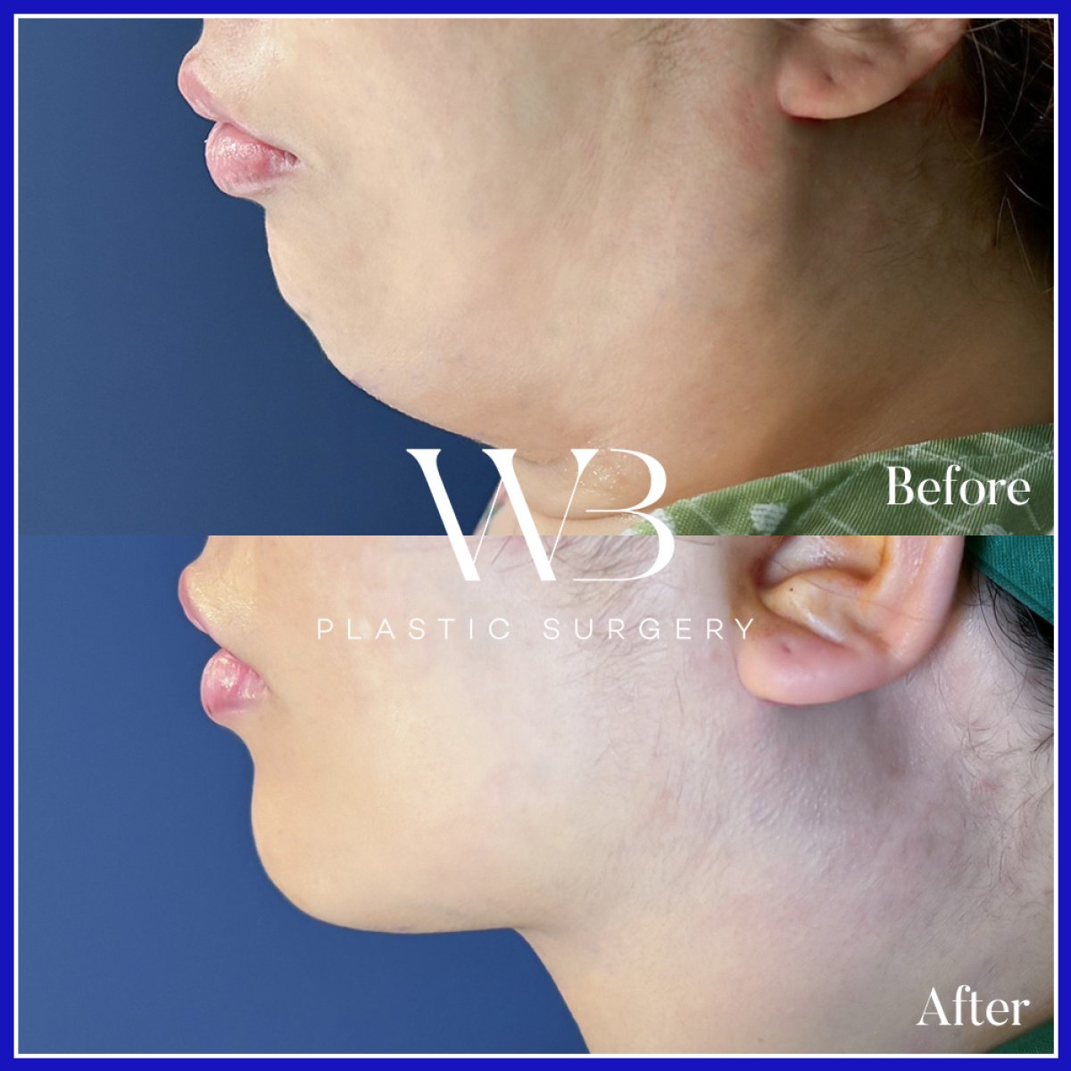 Результат липосакции второго подбородка до и после в WillBe Plastic Surgery Clinic, четкая линия подбородка