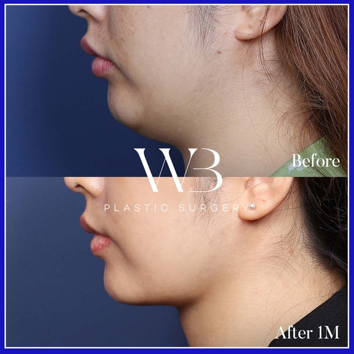 Результаты липосакции второго подбородка до и после в WillBe Plastic Surgery Clinic, улучшенная линия подбородка