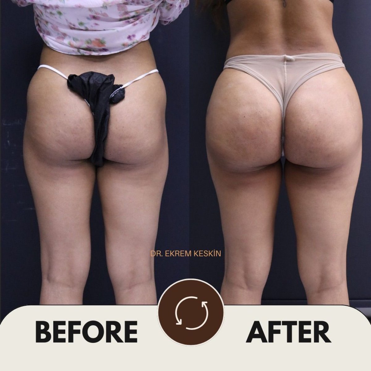 Before and after Brazilian Butt Lift results at Ekrem Keskin – enhanced buttock contour