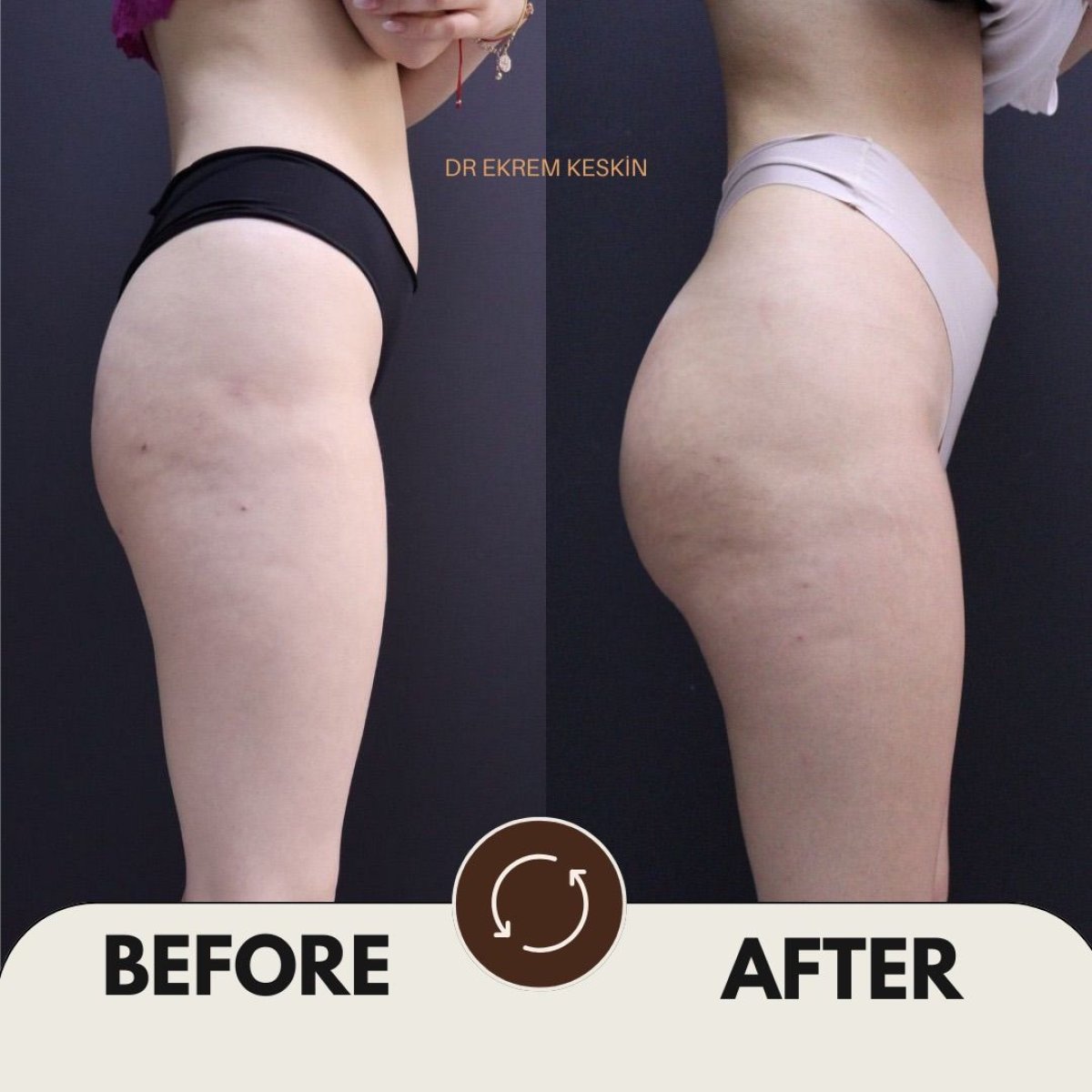 Before and after Brazilian Butt Lift results at Ekrem Keskin – enhanced buttock contour