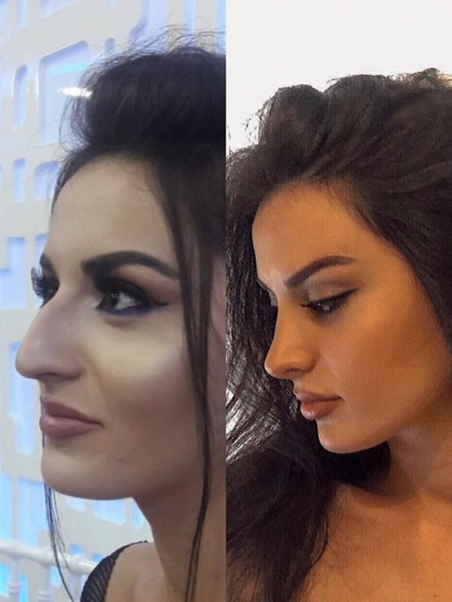 Before and after rhinoplasty results at Ekrem Keskin, nose reshaping with natural profile