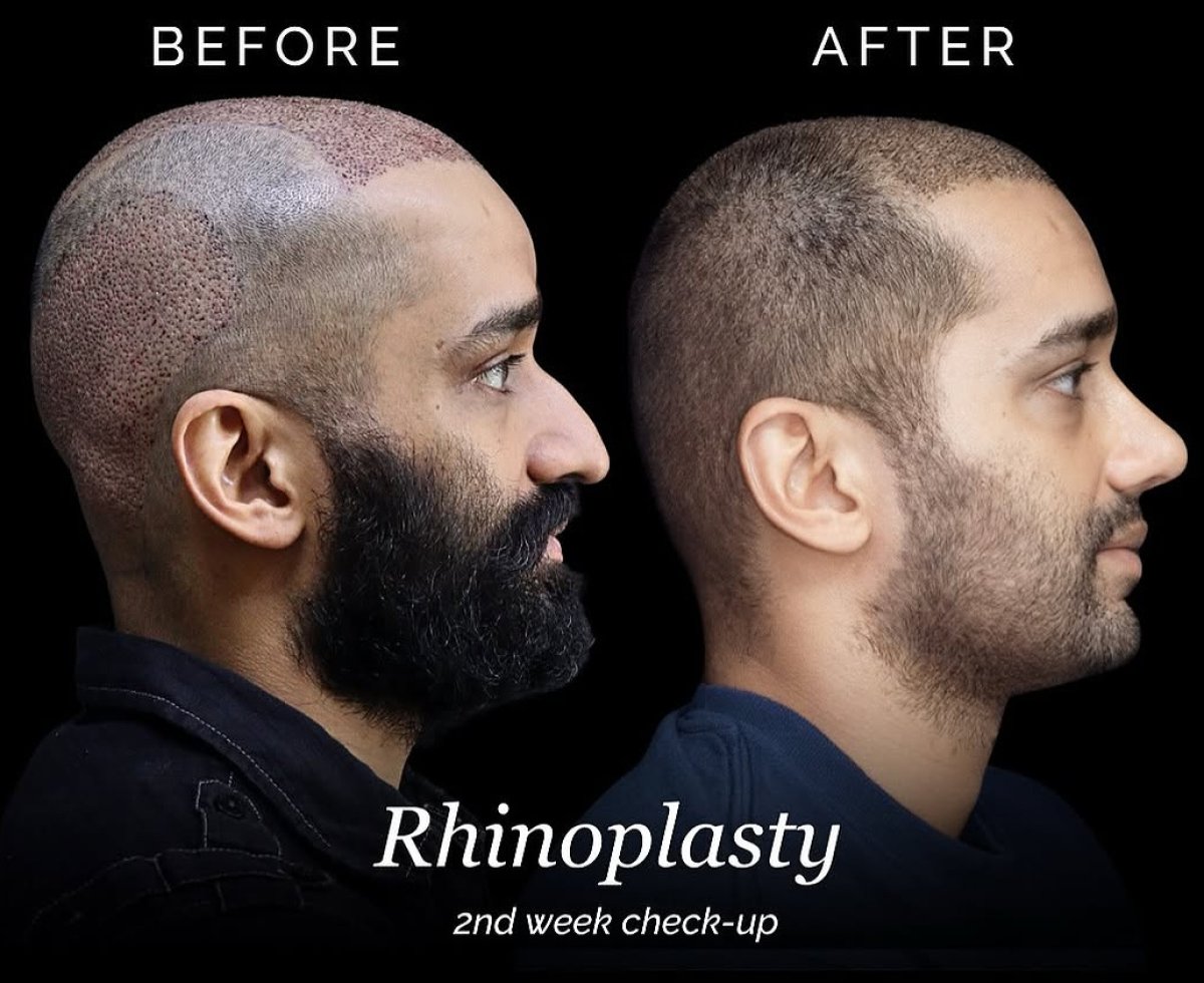Before and after rhinoplasty results at Ekrem Keskin, improved nose shape at 2 weeks