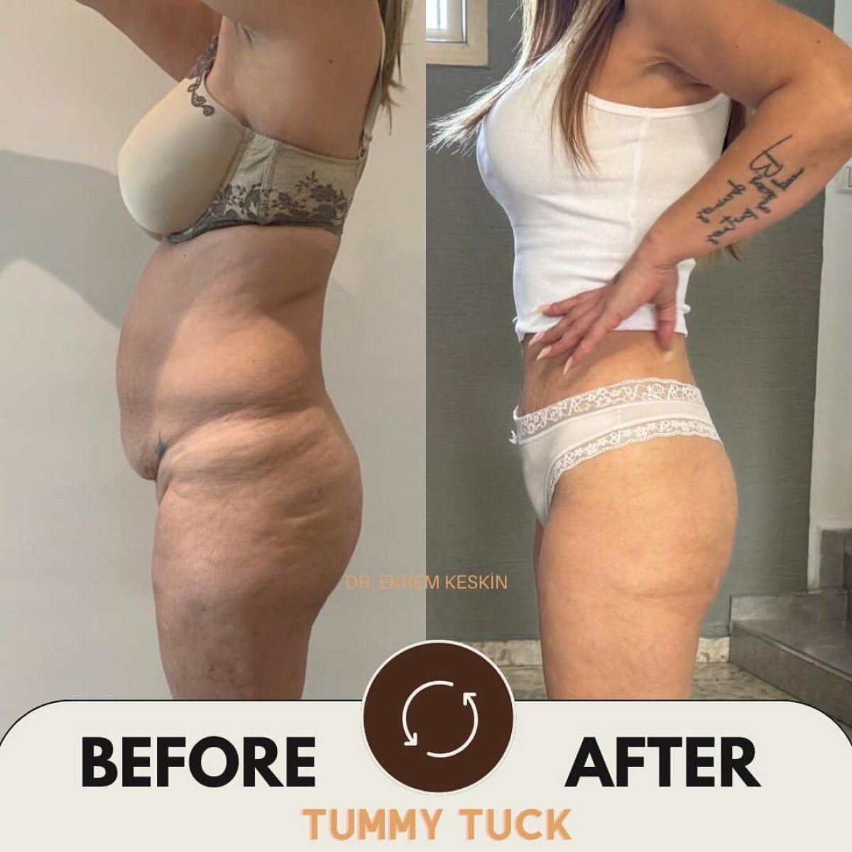 Before and after tummy tuck results at Ekrem Keskin – visible abdominal contour improvement