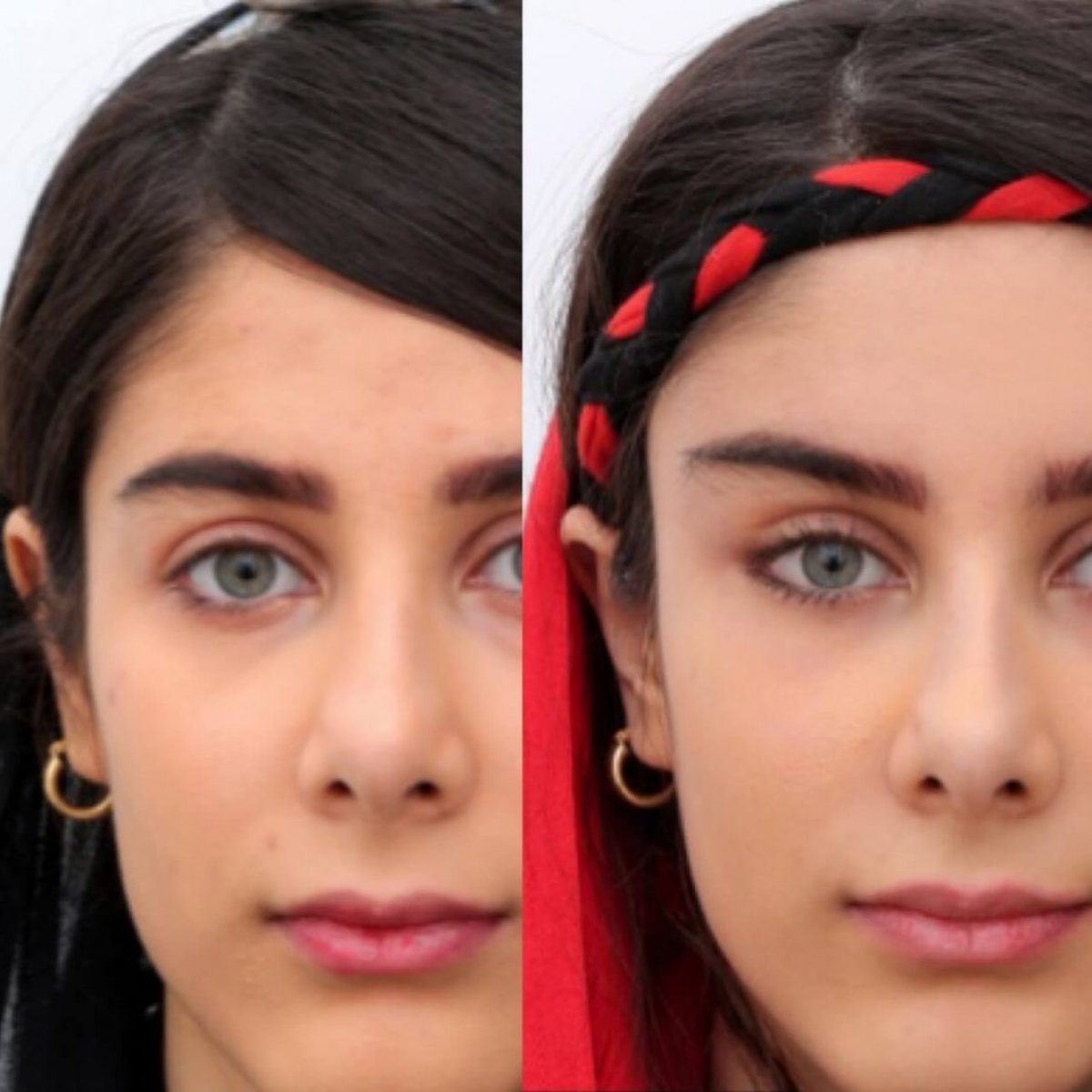 Before and after brow lift results at Ekrem Keskin, visible eyebrow elevation and symmetry