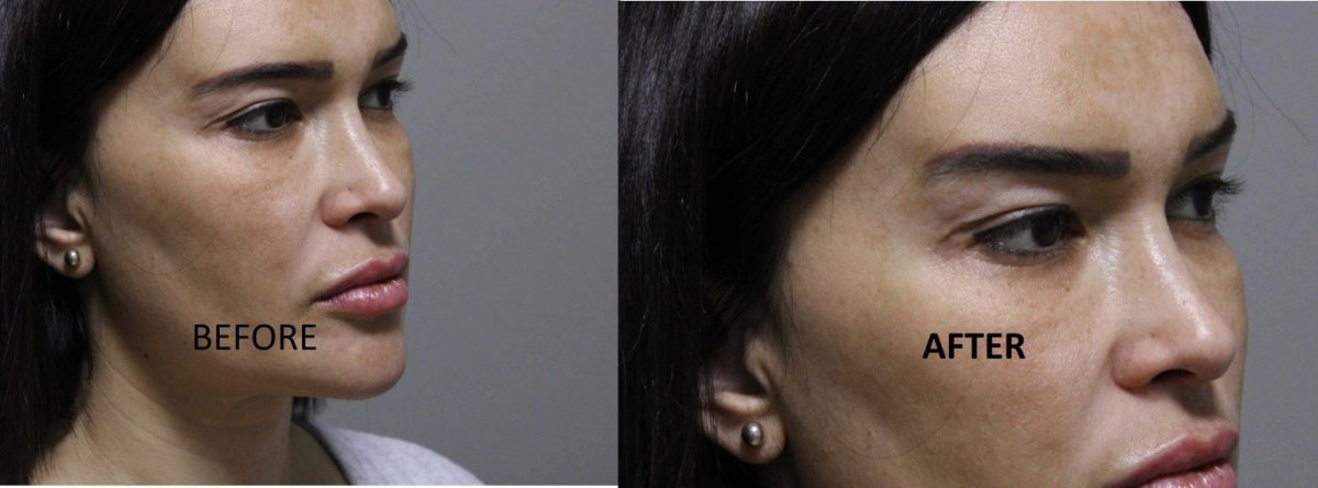 Before and after brow lift results at Ekrem Keskin, visible eyebrow and forehead lift