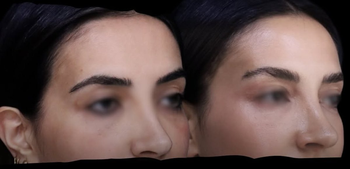 Before and after brow lift results at Ekrem Keskin, visible eyebrow elevation and smoother forehead