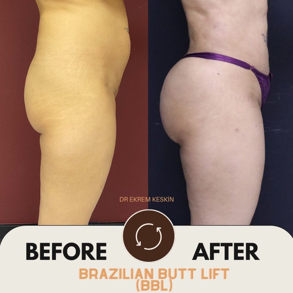 Before and after Brazilian butt lift (BBL) results at Ekrem Keskin, enhanced buttocks shape