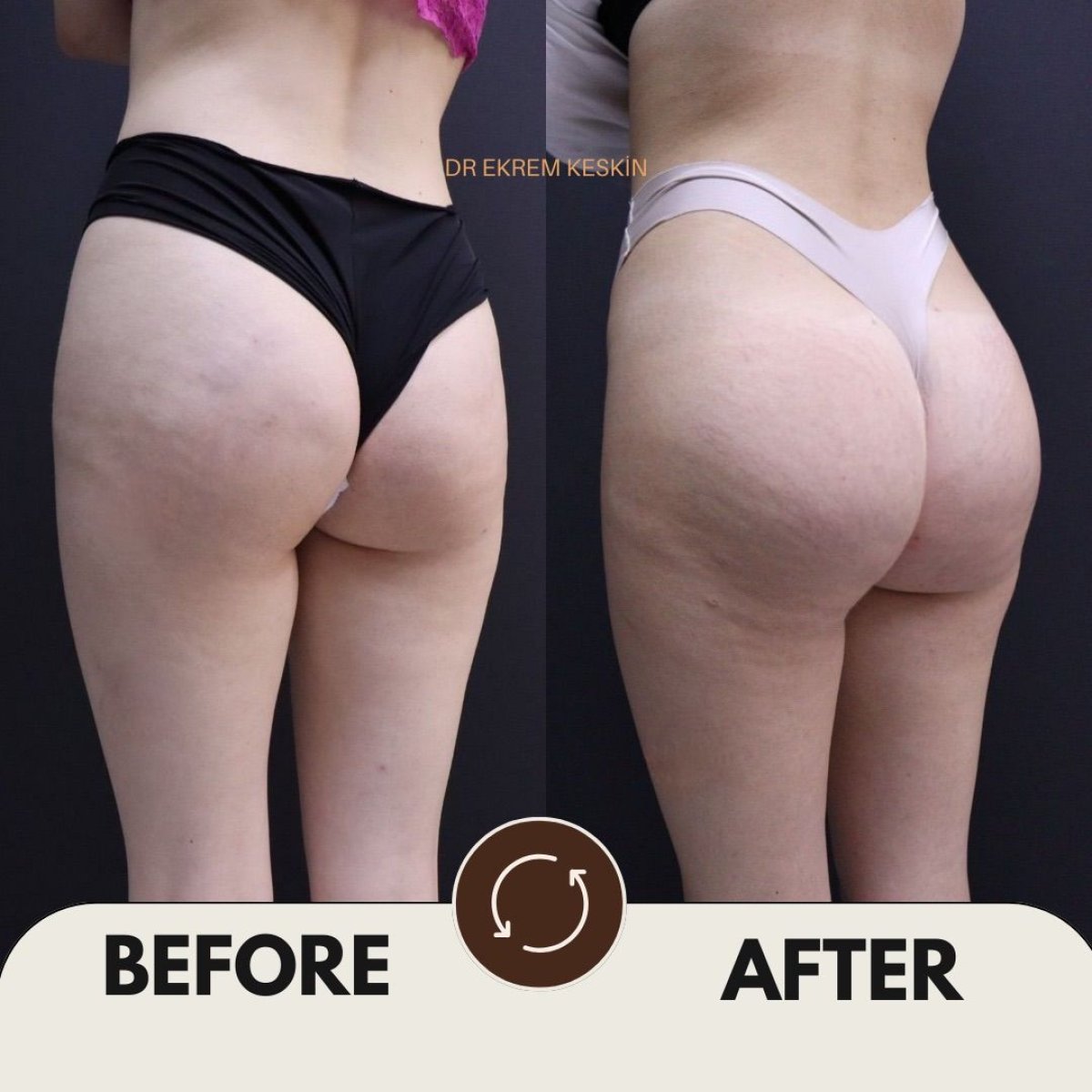 Before and after buttock lift results at Ekrem Keskin clinic, improved contour and lift