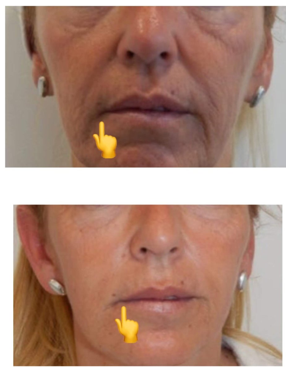 Before and after fillers injection at Ekrem Keskin, visible reduction of facial wrinkles result