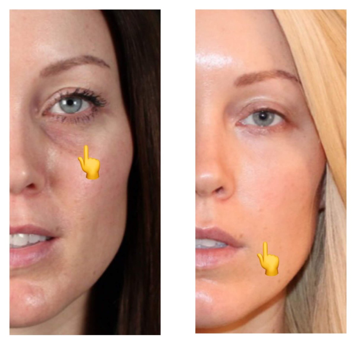 Before and after fillers injection at Ekrem Keskin, under-eye area rejuvenation result