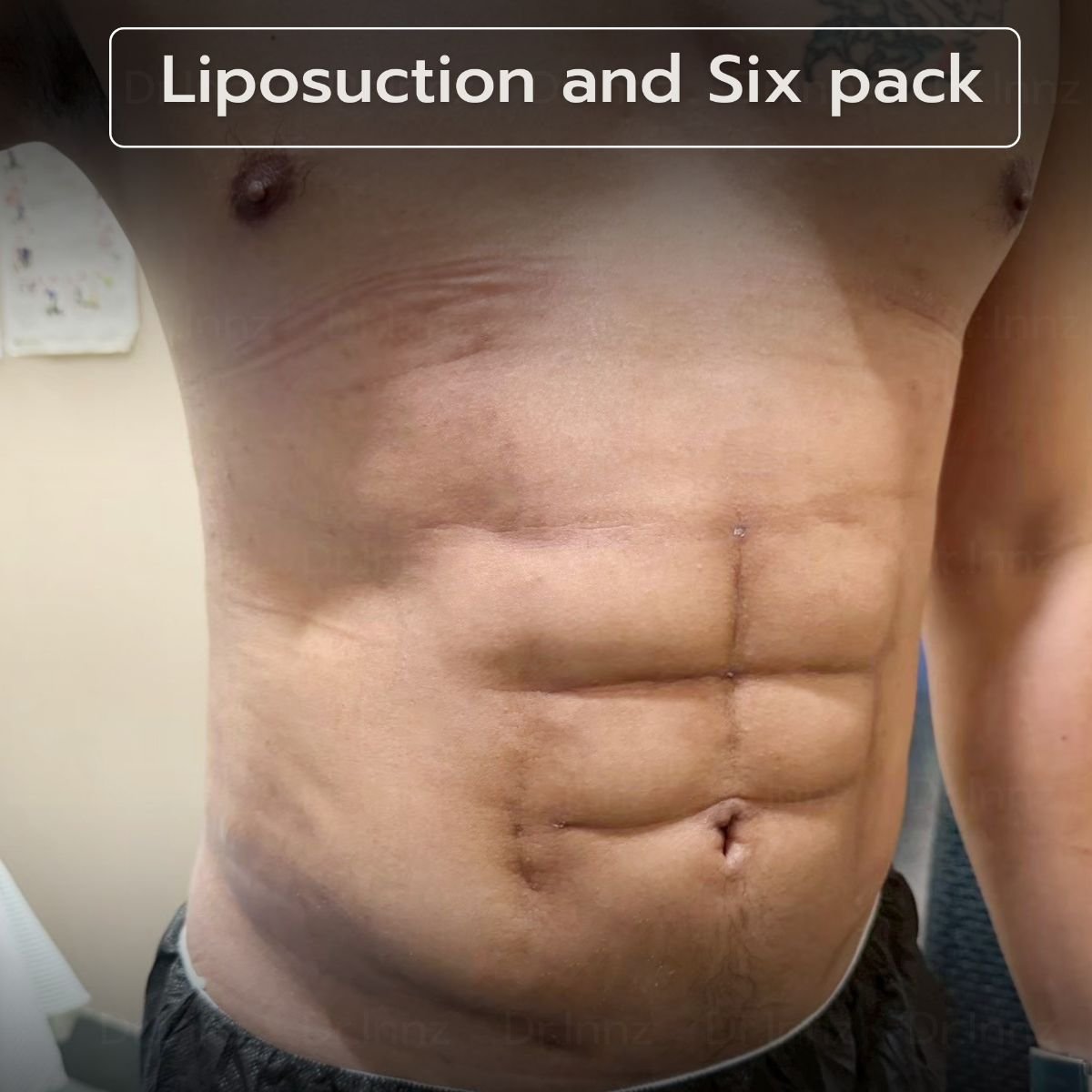 Résultat de liposuccion et six pack à Intrarat Hospital – abdos définis après remodelage