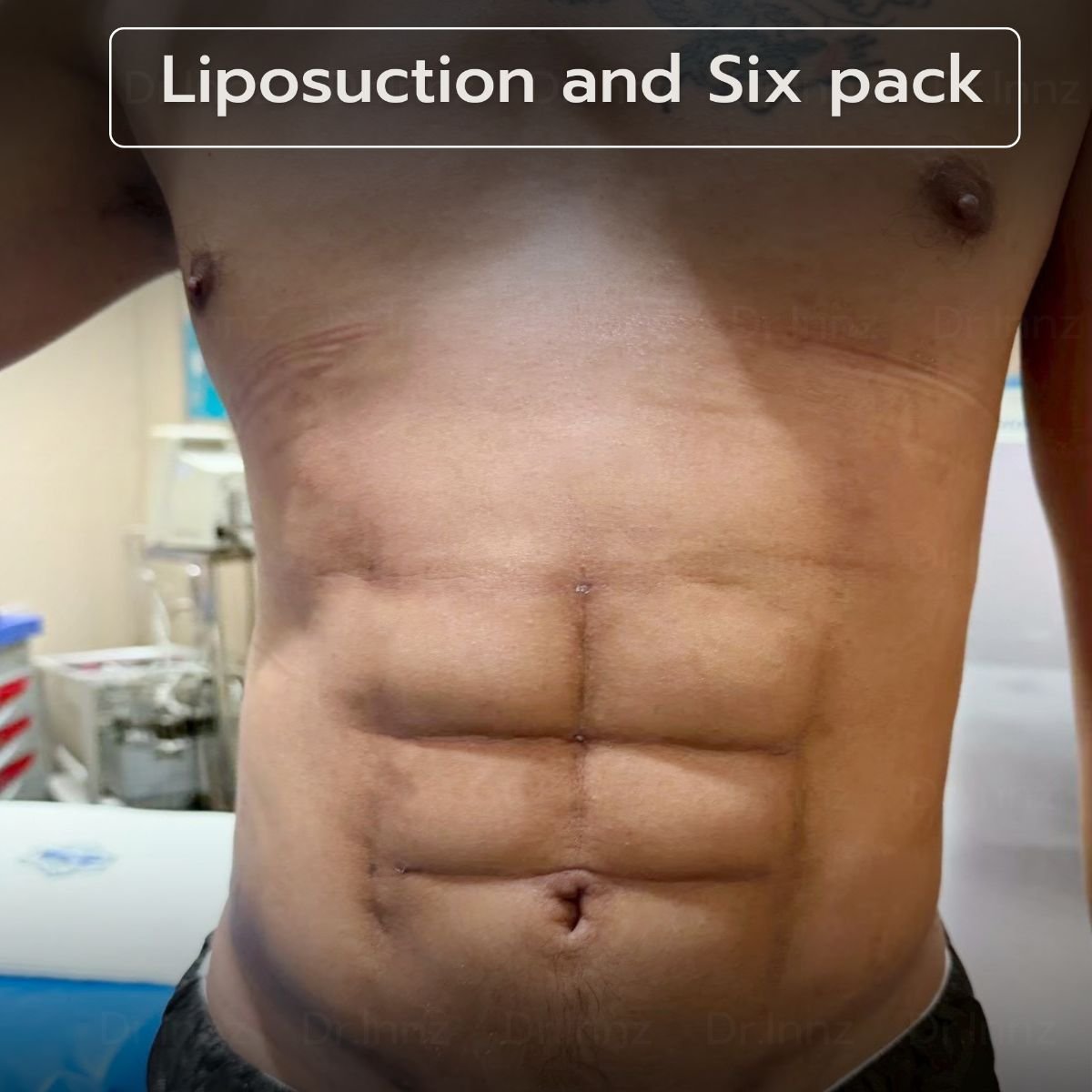 Résultat de liposuccion et abdos sculptés à Intrarat Hospital – ventre défini