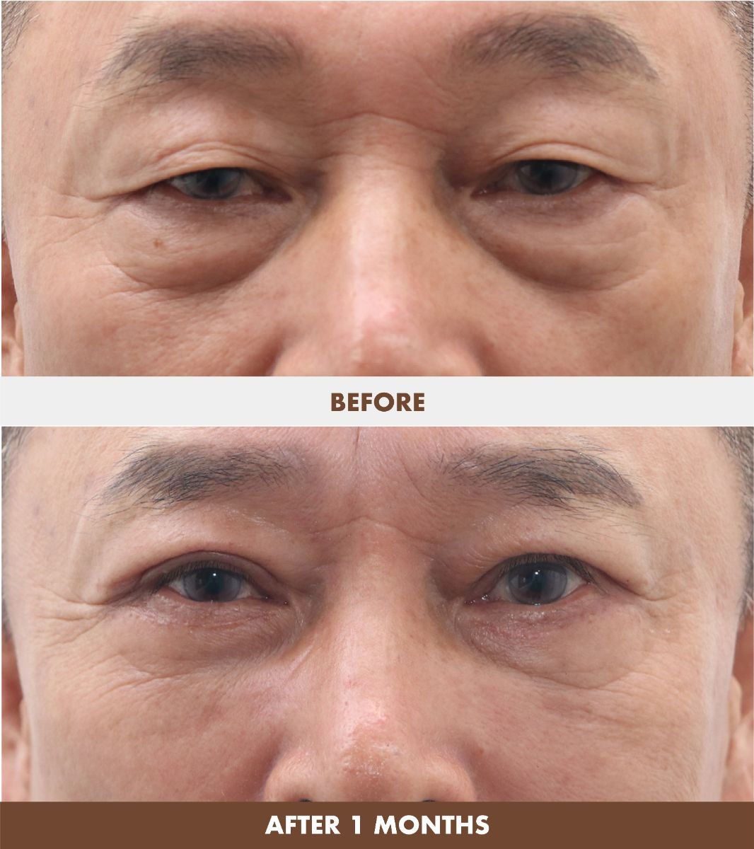 Efekty liftingu twarzy przed i po w Dr. Tak Plastic Surgery, odmłodzenie okolic oczu