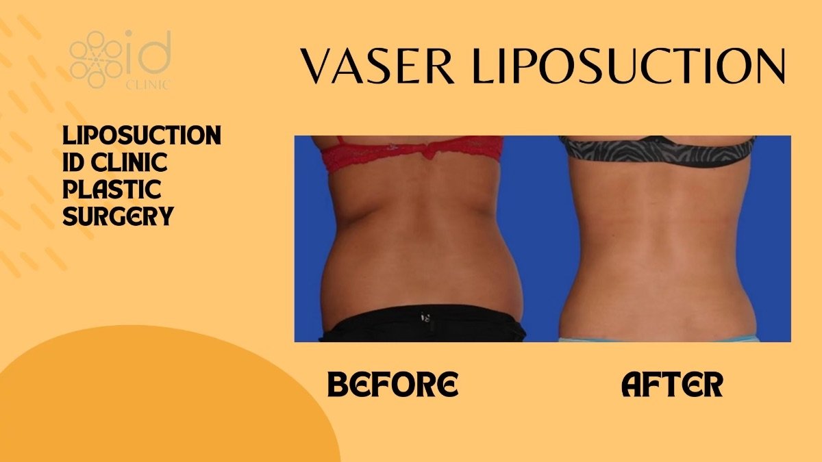Before and after VASER liposuction results at ID Clinic Bangkok, visible waist contouring