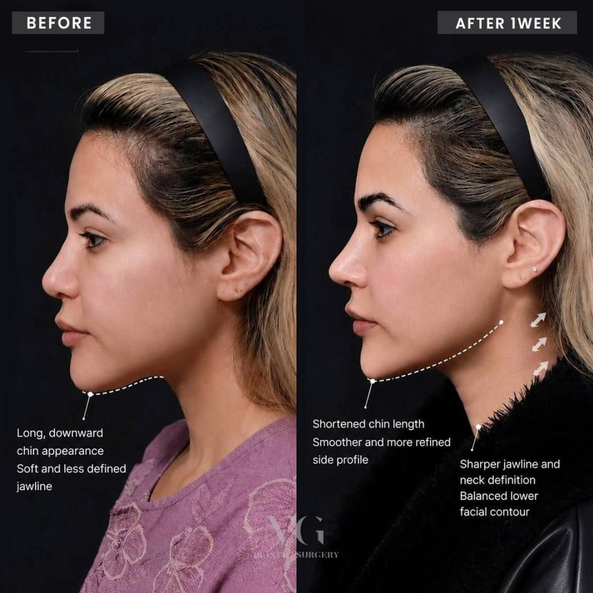 До та після ниткового ліфтингу у VG Plastic Surgery – покращений контур підборіддя і щелепи