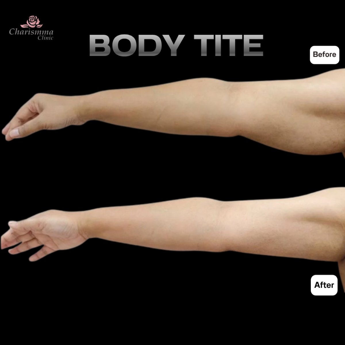 Результати до і після BodyTite на руках у Charismma Clinic, помітне підтягнення шкіри