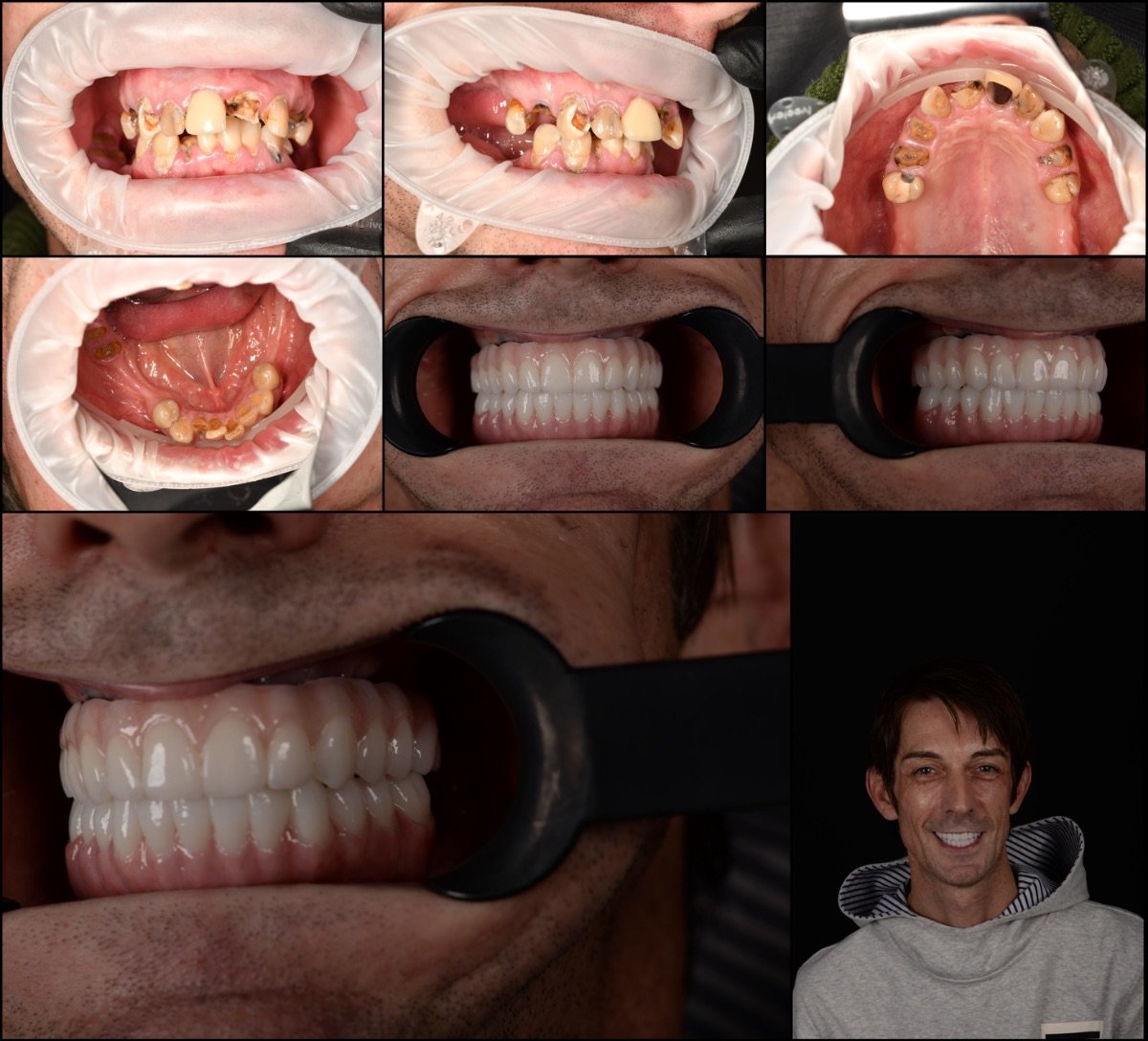 نتائج زراعة الأسنان قبل وبعد في عيادة RIKOTA – استعادة الابتسامة بالكامل