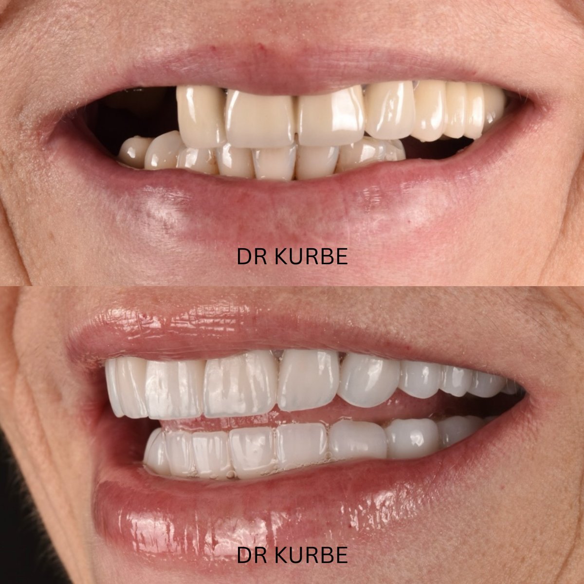 نتائج قبل وبعد تركيب تيجان الزركونيا في عيادة Dr Kurbe، تحول الابتسامة