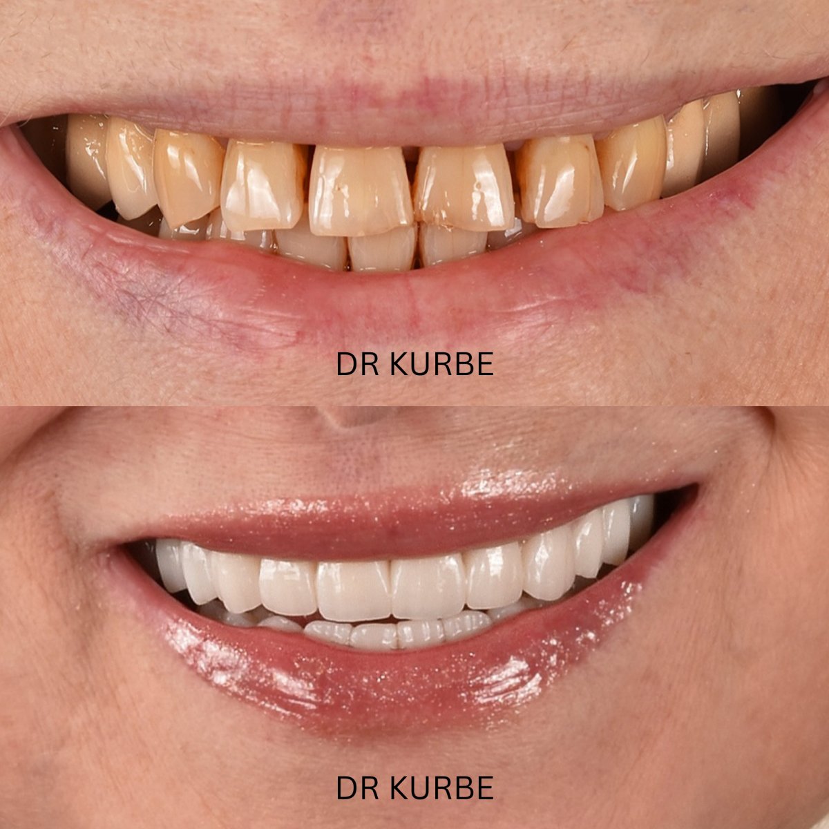 Hollywood Smile before and after results at Dr Kurbe clinic – whiter, even teeth transformation