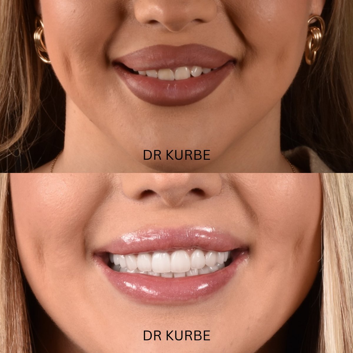Résultats avant/après Hollywood Smile à la clinique Dr Kurbe – transformation visible du sourire