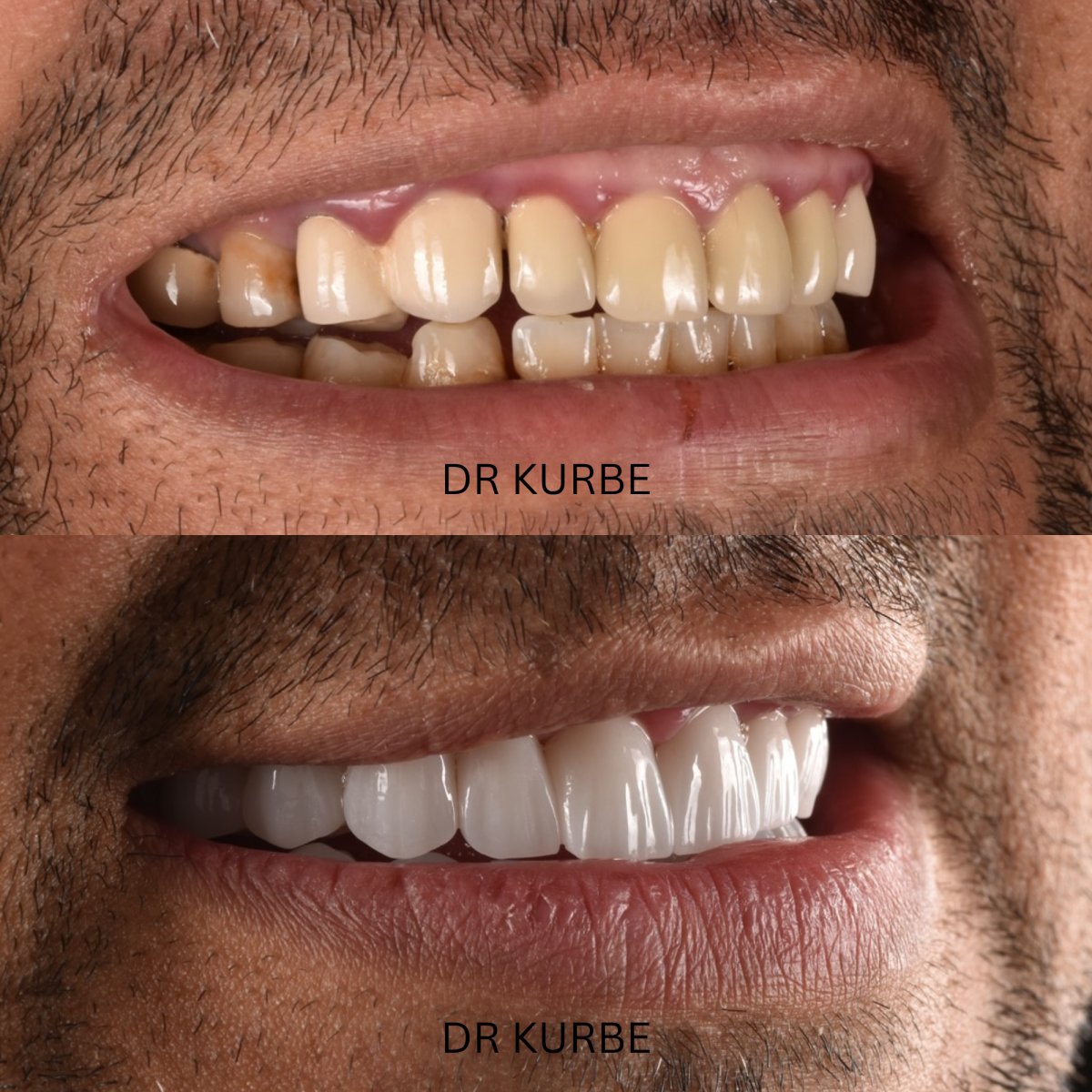 Before and after zirconia crown installation at Dr Kurbe clinic – smile transformation result