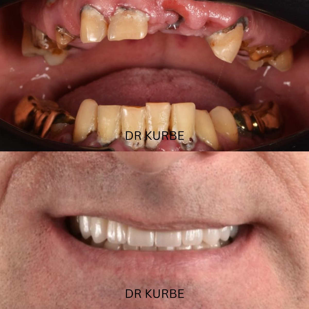 Résultat avant/après implants All-on-4 à la clinique Dr Kurbe – restauration du sourire