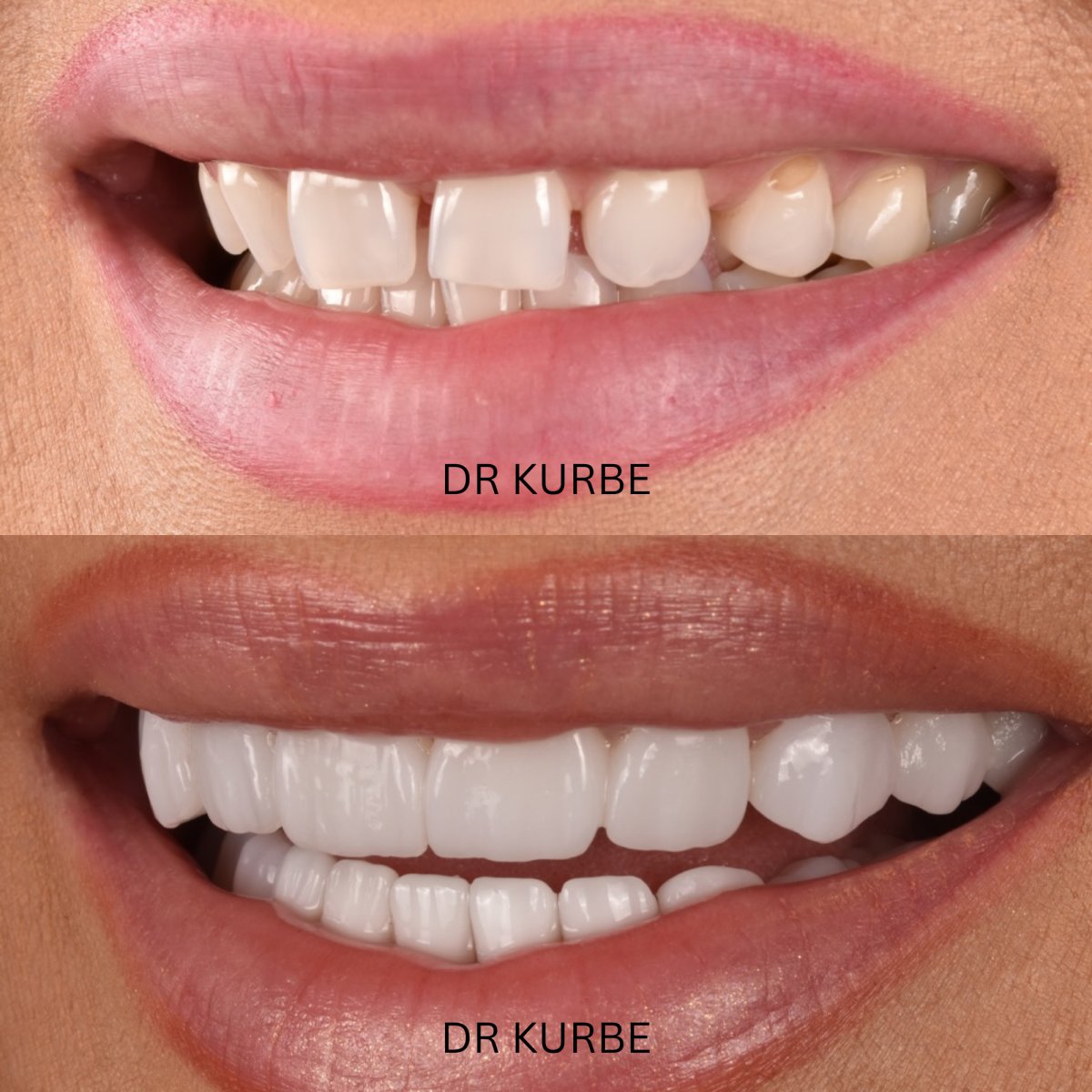 نتائج قبل وبعد ابتسامة هوليود بالفينير لدى Dr Kurbe، تحول الابتسامة