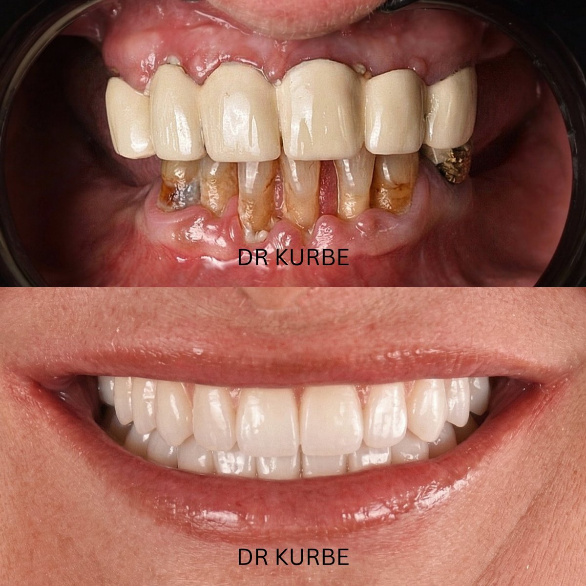 Resultados antes y después de coronas de zirconia en clínica Dr Kurbe – restauración de sonrisa