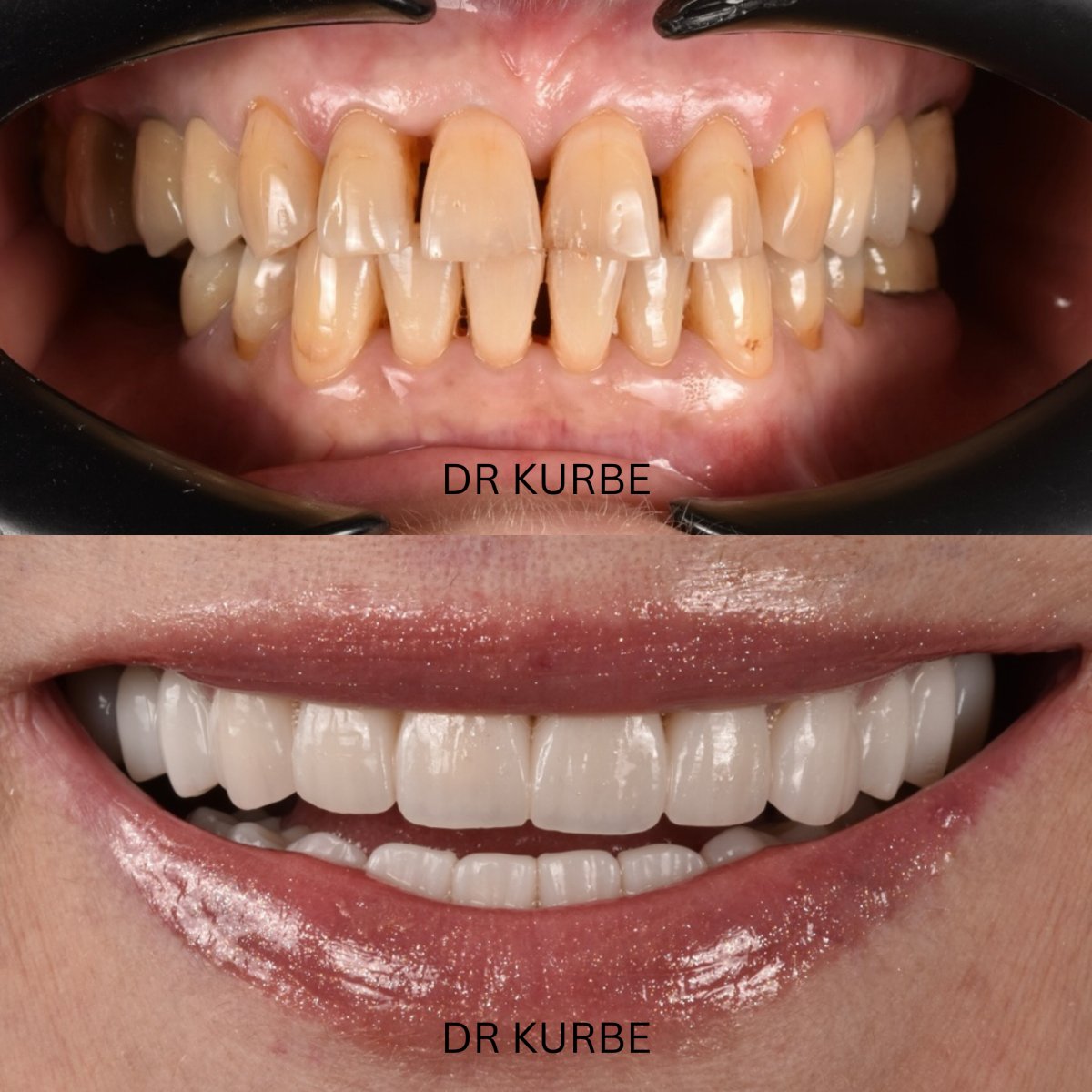 Resultados de antes y después de Hollywood Smile en clínica Dr Kurbe – transformación con carillas